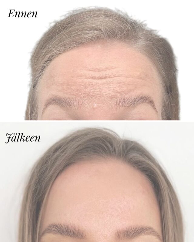 Esteettinen vs lääkinnällinen botox – mitä eroa? 💉Kuvassa näkyvä muutos on Ville Männistön kädenjälkeä ✨ @ville.aestheticBotuliinihoitoja käytetään sekä ulkonäköön liittyviin toiveisiin että erilaisten lihasperäisten oireiden hoitoon.✨ Esteettinen botox
– pehmentää juonteita ja ryppyjä
– yleisiä alueita: otsa, kulmien väli, silmänympärykset
– tavoitteena levänneempi ja huolitellumpi ilme🧑‍⚕️ Lääkinnällinen botox
– käytetään mm. purentalihasten jännitykseen (bruksismi)
– voi helpottaa päänsärkyä ja migreenioireita
– auttaa leukojen kipuun ja kiristykseen👉 Kyseessä on sama lääkeaine, mutta eri käyttötarkoitus.
Molemmissa korostuu tarkka anatomian tuntemus ja yksilöllinen suunnittelu.Ville Männistö on suu- ja leukakirurgi, joka tekee sekä esteettisiä että lääkinnällisiä botuliinihoitoja Firm Medical Spassa.📅 Varaa aika
📩 DM tai ajanvaraus linkistä#firmmedicalspa #esteettinenlääketiede #esteettinenhoitola #esteettinenlääkäri #botuliinihoidot #botoxhoidothelsinki