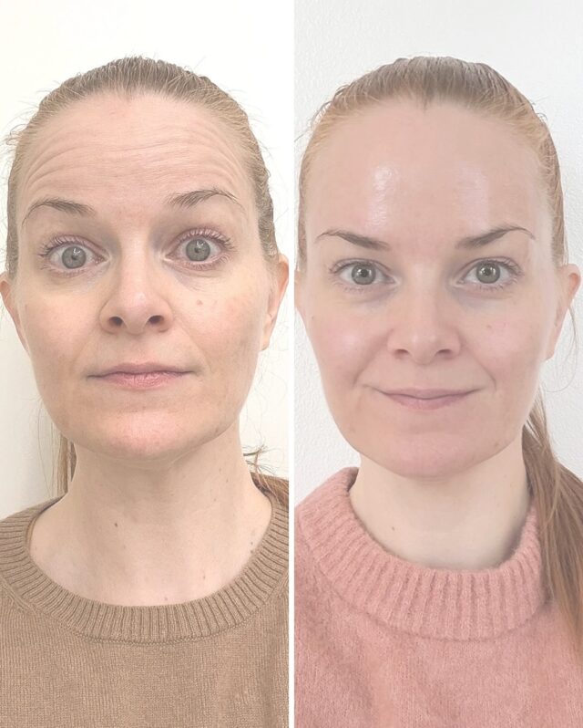 ✨ Botox-hoito – mitä muutosta tässä kuvassa oikeasti näkyy?🔎 Botuliinihoito ei täytä eikä ”muokkaa” kasvonpiirteitä. Sen sijaan se rentouttaa tiettyjä kasvojen lihaksia, jotka toistuvalla liikkeellään aiheuttavat otsalle ja kulmien väliin uurteita.❕Tässä hoidossa vaikutus näkyy erityisesti:
• Otsan lihasjännityksen vähenemisenä → sileämpi, tasaisempi iho
• Kulmien välisen lihastyön rauhoittumisena → vähemmän jännittynyt, levänneempi ilme
• Yläkasvojen harmonisena rentoutumisena → katse avautuu ja ilme pehmenee luonnollisesti.❓Miksi lopputulos näyttää näin raikkaalta?
Botuliini vapauttaa kasvojen turhaa ylijännitettä. Kun lihas ei enää tee jatkuvaa ”rypistysliikettä”, iho saa hetken hengähtää ja pintarypyt tasoittuvat.
Samalla ehkäistään juonteiden syvenemistä tulevaisuudessa — tämä on yksi hoidon suurimmista hyödyistä.❓Miltä hoito tuntuu?
Pieniä, nopeita pistoksia → ei toipumisaikaa → tulokset alkavat näkyä 4–7 päivässä ja ovat saavuttaneet täyden tehon 2 viikon kohdalla.Lopputulos ei koskaan ole ilmeetön.
Tavoitteena on hallittu, luonnollinen rentous, jossa ilmeet säilyvät mutta kireys poistuu.Hoidon teki @ville.aesthetic 💉✨