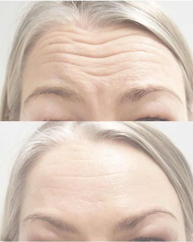 ✨ Botuliini – enemmän kuin vain juonteiden silotus ✨Botuliinihoidolla voidaan hienovaraisesti tasapainottaa kasvojen ilmettä ja korostaa luonnollisia mittasuhteita. Hoidolla voidaan esimerkiksi:⭐️ avata katsetta ja keventää yläluomien raskautta
⭐️ pehmentää tai kaventaa kasvojen yleisilmettä
⭐️ korjata ienhymyä
⭐️ kääntää ylähuulta kauniisti näkyviin ilman volyymin lisäämistä
⭐️ nostaa suupieliä
⭐️ selkeyttää leukalinjaa
⭐️ terävöittää ja pidentää leuan kärkeäKuvan hoidon on toteuttanut sairaanhoitaja @firm.riikka – huolellisella suunnittelulla ja esteettisellä tarkkuudella.Firm Medical Spassa korkeatasoinen osaaminen yhdistyy kilpailukykyiseen hinnoitteluun.
Tutustu botuliinihoitojen hintoihin ja varaa aika konsultaatioon – suunnitellaan sinulle yksilöllinen, luonnollinen lopputulos. 🤍#firmmedicalspa #botuliini #botox #esteettinenhoito #esteettinensairaanhoitaja #luonnollinenkauneus #kasvojenharmonia #lipflip #leukalinja #katseenkohotus #kauneusklinikka #helsinkibeauty #aestheticnurse #medicalaesthetics