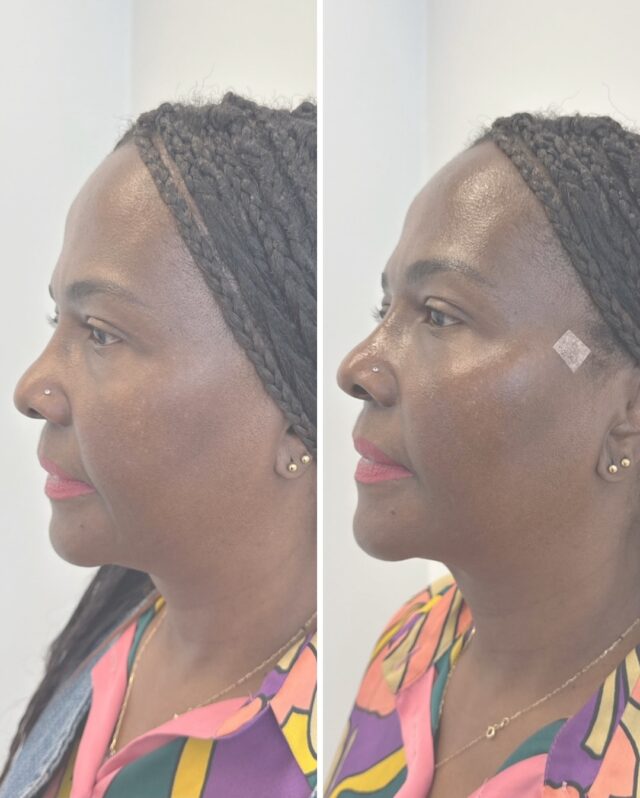 ✨ Väkälangat – luonnollista kohotusta ilman kirurgiaa ✨Kuvassa ennen ja jälkeen -tulos väkälangan nostosta, hoidon tehnyt sairaanhoitaja @firm.saara 🫶Väkälangat antavat kasvoille kevyen kohotuksen ja napakkuutta – erityisesti poskien, leukalinjan ja kasvojen keskiosan alueelle.Tulokset näkyvät heti, ja iho jatkaa kiinteytymistä seuraavien viikkojen aikana, kun oma kollageenituotanto aktivoituu.Varaa maksuton konsultaatio ja kuule, olisiko tämä hoito sinulle sopiva vaihtoehto 💛#firmmedicalspa #vantaa #väkälangat #threadlift #esteettinenhoitolavantaa #kauneudenasiantuntija #ihonkiinteytys #kasvojenkohotus #firmvantaa #esteettinenhoito