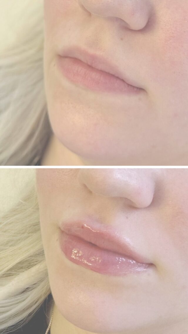 💉 Täyteaineenpoisto ja huulten muotoilu⁠
⁠
Täyteaineenpoisto on yleinen ja turvallinen hoito, kun aiempi huulten muotoilu ei ole tuottanut toivottua lopputulosta. Vanha täyteaine voidaan poistaa ja huulten muoto suunnitella uudelleen yksilöllisesti asiakkaan toiveiden mukaan.⁠
⁠
Firm Medical Spassa emme käytä Russian Lips -tekniikkaa, koska se voi aiheuttaa arpikudosta huuliin ja täyteaineet leviävät helposti huulirajan yläpuolelle. Haluamme varmistaa, että huulten muotoilu on turvallista, luonnollista ja pitkäkestoista.⁠
⁠
Näyttävät huulet voidaan toteuttaa hallitusti ja turvallisesti laadukkailla Juvederm- ja Restylane-täyteaineilla, juuri sinun toiveidesi mukaisesti.⁠
⁠
▶️ Katso videolta Firmin suu- ja leukakirurgi Ville Männistön ja esteettisen sairaanhoitajan Saara Räsäsen kommentit 👌🏻