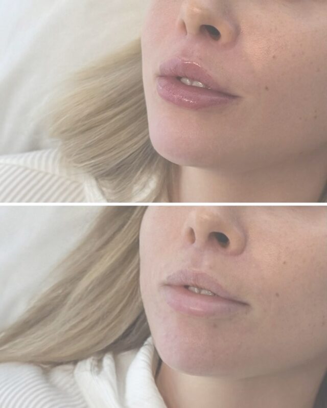 ✨ Joskus on paras aloittaa alusta ✨Näissä huulissa oli aiemmin muualla tehtyjä täytteitä, jotka olivat russian lips -tekniikan seurauksena levinneet ylähuulen punarajan yli. Lopputulos ei enää näyttänyt luonnolliselta eikä tuntunut asiakkaasta omalta.Marraskuussa poistettiin kaikki vanhat täytteet, jotta huulet saatiin palautettua mahdollisimman luonnolliseen pohjaan 💉Nyt huulet on täytetty uudelleen meillä Firmissä @firm.saara toimesta käyttäen täyteaineena pehmeää Juvederm Volbellaa – todella maltillinen määrä, vain 0,45 ml 🤍Tavoitteena ei ollut isot huulet, vaan tasapainoinen, pehmeä ja luonnollinen lopputulos, joka kunnioittaa huulten omaa muotoa 👄#firmmedicalspa #huulitäytteet #juvedermvolbella #naturalresults #russianlips
