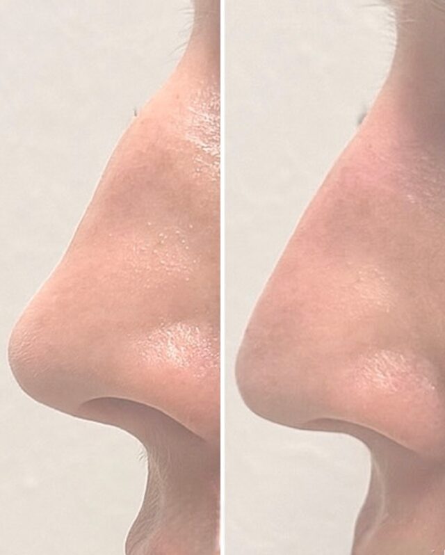 🔬 Nenän muotoilu täyteaineellaKuvassa ennen–jälkeen-muutos nenän ei-kirurgisesta muotoilusta.
Hoidossa täyteainetta on käytetty nenän dorsaalilinjan tasoittamiseen ja profiilin harmonisointiin kasvojen mittasuhteet huomioiden.Toimenpiteen tavoitteena on luonnollinen lopputulos, jossa nenän muoto paranee ilman kirurgista leikkausta.👨‍⚕️ Hoidon on tehnyt suu- ja leukakirurgi Ville Männistö
📍 Firm MedicalHoito suunnitellaan aina yksilöllisesti potilaan anatomian ja turvallisuuden lähtökohdista.#firmmedical #nenänmuotoilu #täyteaine #esteettinenlääketiede #ennenjälkeen #eikirurginennenänkorjaus