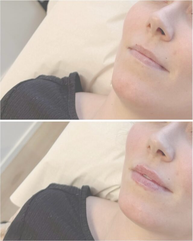 Huultenmuotoilu ennen & jälkeen 💉💋Tässä lopputulos heti hoidon jälkeen.
Huuliin käytettiin Juvedermia 0,55 ml tavoitteena kevyt täyteläisyys, huulten muodon korostaminen sekä tasaisempi kokonaisuus.Kuvissa näkyy erityisesti:
– ylähuulen rajauksen korostuminen
– pehmeämpi symmetria
– hieman lisää volyymia ilman liian voimakasta muutostaLopputulos pehmenee vielä paranemisen aikana.Hoidon toteutti sairaanhoitaja @firm.ninia ✨