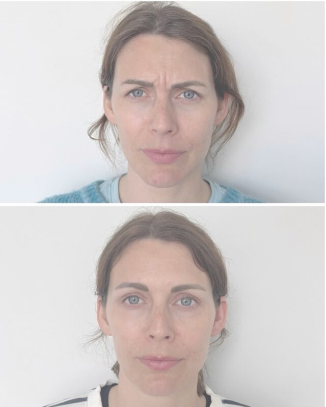 Sibeliusryppy on kulmien väliin muodostuva pystysuuntainen juonne, joka syntyy ilmeillessä – esimerkiksi kun kurtistat kulmia tai keskityt. Toistuva lihastyö voi ajan myötä syventää juonnetta pysyväksi myös levossa.Botuliinihoidolla lihasaktiivisuutta rauhoitetaan ja rypyn ilmettä pehmennetään, jolloin katse kirkastuu ja ilme näyttää levänneemmältä ja huolitellulta.Ennen & jälkeen -kuvassa näet hoidon vaikutuksen ✨
Hoidon on toteuttanut taitava sairaanhoitajamme @firm.ninia 💉