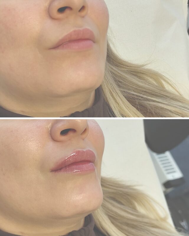 💋 Luonnollista huulten muotoilua eri ikäisilleHuulten muotoilu ei ole vain nuorille – se voi kauniisti korostaa omia piirteitä myös keski-iässä ja myöhemmin. Tässä hoidossa asiakkaan toiveena oli luonnollinen lopputulos: hieman lisää muotoa, kosteutta ja pehmeää täyteläisyyttä huuliin.✨ huulten muodon tasapainotus
✨ kevyt ja luonnollinen volyymi
✨ raikkaampi ja kosteutetun näköinen lopputulosHuulten muotoilu voidaan suunnitella yksilöllisesti kaikenikäisille, aina asiakkaan kasvonpiirteet ja toiveet huomioiden.💉 Hoidon toteutti sairaanhoitaja Juuli
📍 Firm Medical SpaVaraa aika konsultaatioon – suunnitellaan yhdessä sinulle luonnollinen lopputulos.#firmmedicalspa #huultenmuotoilu #lipfiller #luonnollinentulos #esteettinenhoitola #juvederm® #aestheticmedicine