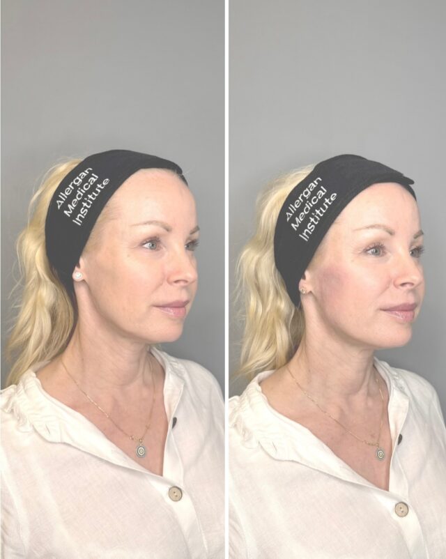 HarmonyCa-hoito lokakuun kampanjassa 990 € (norm. 1200 €)Tämä upea 54-vuotias asiakas on hoitanut ihoaan jo pitkään – säännölliset botuliinihoidot, ihoa syväkosteuttavat hoidot ja huolellinen kotihoitorutiini ovat pitäneet ihon erinomaisessa kunnossa.Viime aikoina hän kuitenkin huomasi, että leukalinja ei ollut enää aivan niin napakka kuin ennen ja iho tuntui kaipaavan pientä lisätukea. Toiveena ei ollut muuttaa piirteitä, vaan säilyttää luonnollinen ilme ja vahvistaa ihoa sisältäpäin.HarmonyCa valittiin hoitomuodoksi, koska se yhdistää hyaluronihapon kosteuttavan vaikutuksen ja kalsiumhydroksiapatiitin kollageenia aktivoivan vaikutuksen – täydellinen yhdistelmä silloin, kun halutaan näkyvää kiinteytystä ja pitkän aikavälin vaikutuksia.Kuvissa näkyy iho ennen ja heti hoidon jälkeen. Lopullinen tulos kehittyy noin kahden kuukauden aikana, kun uusi kollageeni muodostuu ja iho vahvistuu luonnollisesti.Seuraa @firmmedicalspa nähdäksesi lopputuloksen ✨