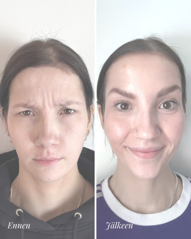 ✨ ENNALTAEHKÄISEVÄ BOTOX – KOKONAISVALTAINEN, LUONNOLLINEN TULOS ✨Voiko botoxia tehdä ennen kuin rypyt ovat pysyviä? Kyllä – ja tässä on hyvä esimerkki siitä, miksi 👇Kuvissa näkyy otsan aktiivinen lihastyö ilmeillessä, mikä ajan myötä johtaa pysyviin juonteisiin. Hoidolla lähdettiin ennaltaehkäisemään tätä kehitystä ja pehmentämään ilmeitä säilyttäen luonnollisuus 💫Tälle asiakkaalle tehtiin:
💉 vaakajuonteet (otsa)
💉 glabella (sibeliusjuonne)
💉 silmänympärykset
💉 lip flipLopputulos?
✔️ pehmeämmät ilmeet
✔️ vähemmän “kiristävä” otsa ilmeillessä
✔️ raikkaampi ja levänneempi kokonaisuus
✔️ huulet kevyesti korostuvat ilman täyteaineitaTavoitteena aina tasapainoinen ja huomaamaton lopputulos – ei ilmeettömyys 🙌💉 Hoidon toteutti lääkäri Aurora
📍 Firm Medical SpaHaluatko tietää, sopiiko ennaltaehkäisevä botox sinulle? Varaa konsultaatio ✨#botox #lipflip #ennaltaehkäisy #firmmedicalspa luonnollinentulos