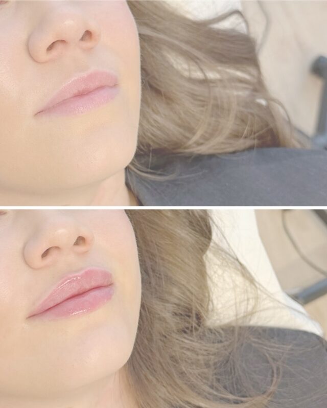 💋 HUULTENMUOTOILU + SUUPIELTEN BOTOX ✨Kun haluat luonnollista volyymia, kauniin muodon ja pehmeämmän ilmeen – tämä yhdistelmä on täydellinen.Huulten täyteainehoidolla voidaan:
✔️ korostaa huulten muotoa
✔️ lisätä pehmeää volyymia
✔️ tasapainottaa symmetriaa
✔️ viimeistellä kauniin ja luonnollisen lopputuloksenSuupielten Botox-hoito auttaa puolestaan:
✨ kohottamaan suupieliä
✨ vähentämään “surullista” ilmettä
✨ tekemään kasvojen ilmeestä raikkaamman ja levänneemmänTulos on harmoninen ja huoliteltu – mutta silti täysin sinun näköinen 💗Tämän kauniin muutoksen on toteuttanut sairaanhoitaja @firm.ninia 💉✨📍 Firm Medical Spa🎁 HELMIKUUN ETU
Kun varaat huultenmuotoilun helmikuun aikana, saat suupielten Botox-hoidon kaupan päälle.📩 Varaa aikasi DM:llä tai ajanvarauslinkistä.#firmmedicalspa #huultentäyteaine #lipfiller #huultenmuotoilu #botox #suupieltenbotox #aestheticclinic #beforeafter #naturalresults #kauneushoidot #täyteainehoito #lipsfinland #firmninia