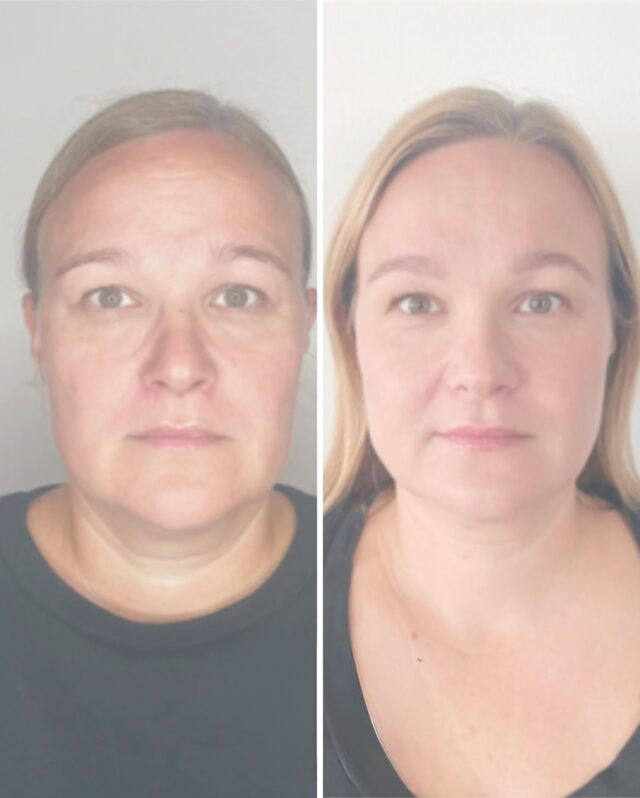 ✨ Veitsetön kasvojenkohotus HarmonyCa®-hoidolla ✨Sano hyvästit hamsteripusseille! HarmonyCa® on uuden sukupolven esteettinen hoito, joka yhdistää kaksi tehokasta vaikuttavaa ainetta: hyaluronihapon (HA) ja kalsiumhydroksiapatiitin (CaHA).🔹 Hyaluronihappo tuo välittömästi volyymia, kosteutta ja tukea kasvoille.
🔹 Kalsiumhydroksiapatiitti stimuloi ihon omaa kollageenin ja elastiinin tuotantoa, mikä vahvistaa ja kiinteyttää ihoa pitkällä aikavälillä.Näin saadaan yhdellä hoitokerralla sekä välitön kohotus että pitkäkestoinen uudistava vaikutus – täysin ilman leikkausta. Tuloksena luonnollinen, raikas ja harmoninen ilme 💫🍂 Lokakuun erikoisetu: HarmonyCa®-hoito 990 € (norm. 1200 €)Varaa aikasi ja anna asiantuntijoidemme suunnitella juuri sinulle sopiva hoito.#harmonyca #veitsetönkasvojenkohotus #ilmanleikkausta #firmmedicalspa #esteettinenhoitolavantaa #kauneudenhoito #antiage