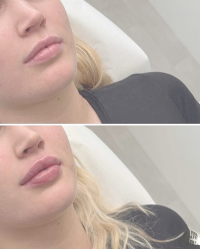 💋 Näyttävät huulet – tyylillä ja taidolla 💋Usein puhutaan “luonnollisesta lopputuloksesta” — mutta aina se ei ole tavoite. Joskus halutaan rohkeasti eroa, enemmän volyymia ja selkeämpi muoto. Näyttävät huulet voivat silti olla harmoniset ja kauniit, kun mittasuhteet tehdään oikein ja aine valitaan huolella.Jos huulia on vuosien varrella täytetty useasti ja muoto on päässyt “elämään”, voi olla viisasta aloittaa alusta: tehdä täyteaineen poisto ja rakentaa lopputulos puhtaalta pöydältä. Näin saadaan siisti, hallittu ja tasapainoinen muoto, joka näyttää hyvältä kaikista kulmista.✨ Firm Medical Span hoitovalikoimaan kuuluu myös täyteaineen poisto, joten huulia voidaan tarvittaessa muotoilla uudelleen turvallisesti ja hallitusti.Tämä upea lopputulos on @firm.ninia’n käsialaa 💉#firmmedicalspa #huultenmuotoilu #lipfiller #täyteaineenpoisto #esteettinenhoitola #esteettinenhoitolavantaa #medicalspa #huultentäyttö #näyttäväthuulet #beautytrends #vantaa