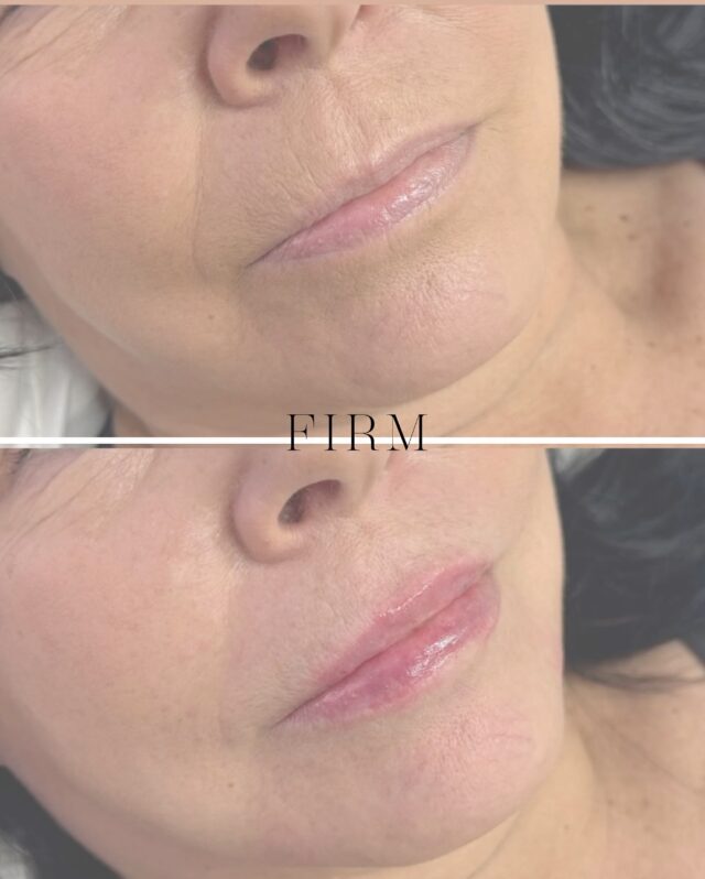 Ajattoman kauniit huulet – huultenmuotoilu ikääntyvälle iholle ja mitä siitä olisi hyvä tietää? 💋Huulten muotoilussa katsotaan kokonaisuutta. Ei vain huulia, vaan myös suun ympärys ilmettä.– huulten muoto ja kosteus
– suupielet ja niiden tuki
– lihastasapaino suun alueella ✨Iän myötä nämä muuttuvat, ja siksi myös hoito mukautuu. Lopputulos voi silti olla yhtä kaunis kaikenikäisille.Huulten muotoilua voidaan varsinkin varttuneemmille asiakkaille tarvittaessa yhdistää suupielten hoitoon esim. mesoterapiaan (polynukleotidit, cellbooster), täyteaineeseen tai botuliiniin, jos halutaan samalla korjata esim. suunympärysalueen juonteita tai alaspäin kääntyviä suupieliä.Tämän tyylikkään lopputuloksen on toteuttanut sairaanhoitajamme @firm.saara. Tuotteena Juvederm Volbella.