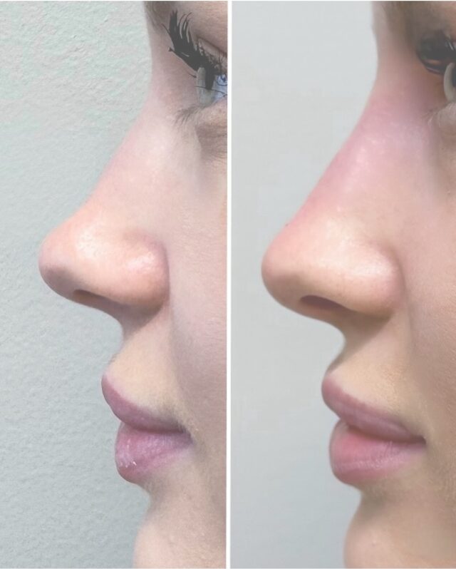 𝐍𝐄𝐍Ä𝐍 𝐌𝐔𝐎𝐓𝐎𝐈𝐋𝐔 𝐓Ä𝐘𝐓𝐄𝐀𝐈𝐍𝐄𝐄𝐋𝐋𝐀👃🏼✨Nenän muotoilu täyteaineella on nopea tapa tasapainottaa profiilia ilman leikkausta. Mutta nenän alue ei ole “peruspistoskohde”.𝐌𝐢𝐤𝐬𝐢 𝐅𝐢𝐫𝐦𝐢𝐬𝐬ä 𝐧𝐞𝐧ä𝐧 𝐦𝐮𝐨𝐭𝐨𝐢𝐥𝐮𝐧 𝐭𝐞𝐤𝐞𝐞 𝐯𝐚𝐢𝐧 𝐥ää𝐤ä𝐫𝐢/𝐤𝐢𝐫𝐮𝐫𝐠𝐢?Nenän alueella kulkee tärkeitä verisuonia ja väärin tehtynä täyteainehoito voi aiheuttaa vakavia komplikaatioita, kuten verenkiertohäiriöitä ja kudosvaurioita.Siksi nenän muotoilu vaatii vahvaa anatomian tuntemusta ja kokemusta – turvallisuus aina ensin.𝐌𝐢𝐤𝐬𝐢 𝐭ä𝐲𝐭𝐞𝐚𝐢𝐧𝐞 𝐞𝐢 𝐬𝐨𝐯𝐢 𝐤𝐚𝐢𝐤𝐤𝐞𝐞𝐧 𝐧𝐞𝐧ä𝐧 𝐤𝐨𝐫𝐣𝐚𝐚𝐦𝐢𝐬𝐞𝐞𝐧?Täyteaineella voidaan muotoilla, mutta sillä ei voida pienentää nenää tai korjata kaikkia rakenteellisia ongelmia.Se sopii parhaiten:
✔️ nenän selän epätasaisuuksiin
✔️ profiilin suoristamiseen
✔️ pieniin epäsymmetrioihin
✔️ nenän kärjen kevyeen kohotukseenMutta jos toiveena on nenän selkeä pienennys tai rakenteellinen muutos, lopputulos vaatii usein leikkauksen.💛 Me Firmissä kerromme aina rehellisesti, oletko sopiva kandidaatti täyteainehoitoon vai onko toivomasi lopputulos sellainen, joka vaatii kirurgisen toimenpiteen.Tämän muutoksen on tehnyt turvallisesti suu- ja leukakirurgi Ville Männistö ➡️ @ville.aesthetic#firmmedical #esteettinenhoitolavantaa #nenäntayteaine #rhinofiller #nosefiller #täyteainehoidot #esteettinenlääketiede