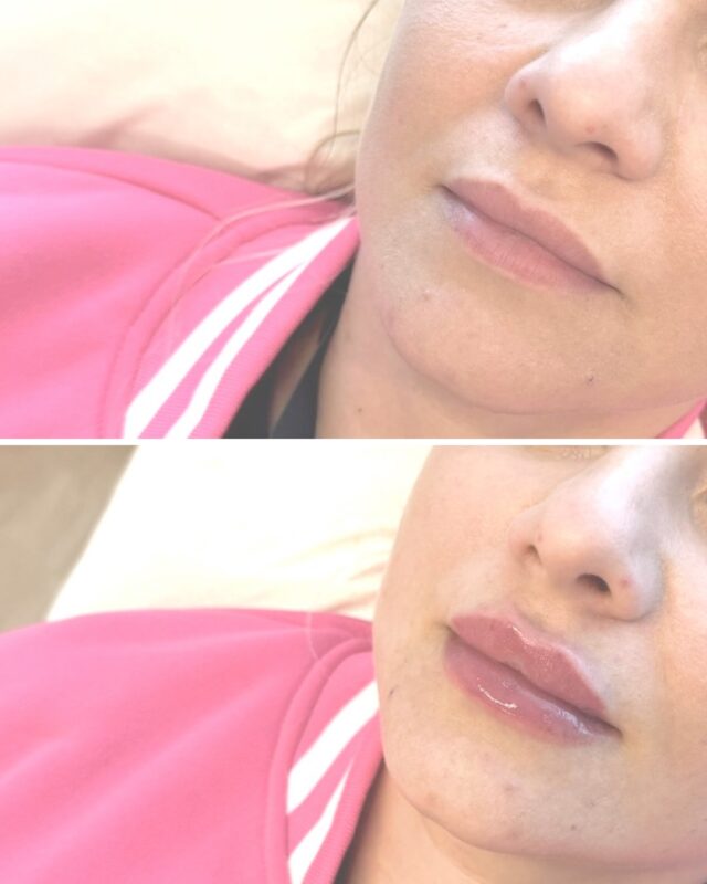 💗 Firm. Clean. Girl. -huulet kesäksiNäissä kuvissa huuliin lisättiin maltillisesti volyymia ja kosteutusta, jolloin lopputuloksesta tuli pehmeämpi, tasapainoisempi ja selkeästi viimeistellympi – kuitenkaan menettämättä luonnollisuutta. ✨Erityisesti ylähuuli sai kaivattua tukea ja muotoa, mikä korostaa koko suun ilmettä kauniisti. Huulet näyttävät terveiltä, kosteutetuilta ja omilta – vain hieman paremmilta.💋 Nämä huulet on muotoillut taitava @firm.saaraKuvat on otettu ennen hoitoa ja heti hoidon jälkeen, joten lopputulos vielä asettuu seuraavien päivien aikana.✨ Aliaxin LV -huulet kesäkuun ajan 299 €Täydellinen valinta sinulle, joka haluat luonnollisen lopputuloksen ilman ylitäytettyä vaikutelmaa.📍 Varaa aikasi Phorestista
📩 Laita viestiä, jos mietit sopisiko hoito juuri sinulle.#aliaxinlv #huultentäyttö #beforeafter #luonnollisethuuleet #firmmedicalspa