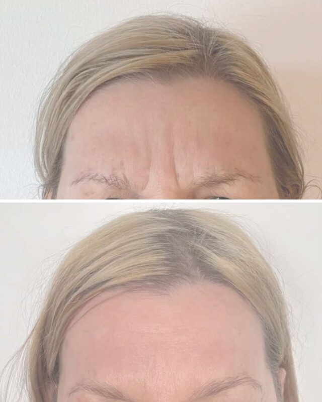 ✨ BEFORE → AFTER ✨Tässä hoidossa emme keskittyneet vain yhteen juonteeseen – vaan koko yläkasvojen tasapainoon.Otsan vaakarypyt + sibeliusryppy (kulmien välinen “11-juonne”) vaikuttavat toisiinsa enemmän kuin moni ajattelee.💉 Kun molemmat alueet hoidetaan samanaikaisesti:
– ilme säilyy luonnollisena
– kulmat eivät “putoa” tai nouse liikaa
– lopputulos on harmoninen, ei jäykkä👩‍⚕️ Lääkäri Aurora eli @dr.auroras suunnittelee jokaisen hoidon yksilöllisesti – tavoitteena levännyt, raikas ilme ✨👉 Mitä mieltä olet lopputuloksesta?#firmmedicalspa #botuliini #botox #esteettinenhoito #esteettinenhoitolavantaa #luonnollinentulos #medicalspa #beforeafter