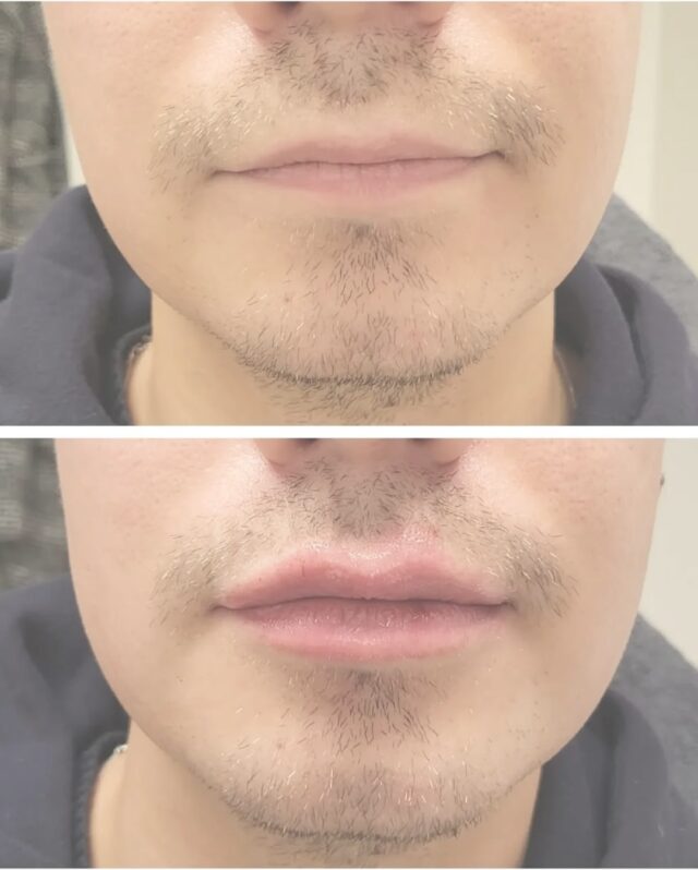 Miesten huultenmuotoilu – luonnollisesti maskuliininen lopputulos 💉✨Huulten muotoilu ei ole vain naisille. Myös miehet voivat korostaa huuliaan huomaamattomasti ja tyylikkäästi – ilman feminiinistä vaikutelmaa.Tavoitteena ei ole ”täyteläiset huulet”, vaan:
• selkeämpi huuliraja
• parempi symmetria
• kevyesti lisää volyymia ja kosteutta
• raikkaampi, levännyt ilmePienillä määrillä ja oikealla tekniikalla saadaan huulista huolitellut – maskuliinisuus säilyttäen.✨ Hoidon toteutti sairaanhoitaja @firm.riikka
Before & After 👆#miestenhoidot #miestenaestetiikka #huultenmuotoilu #maleaesthetics #mensfillers #lipenhancementformen #naturallook #masculinebeauty #menalsogetfillers #aestheticformen #firmmedicalspa #injectornurse #beforeafter