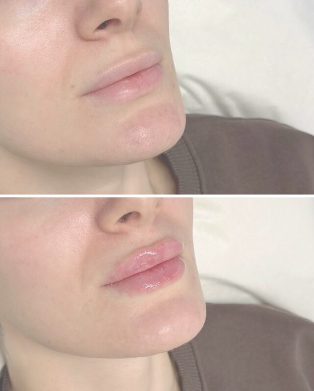 Before ➡️ After 💋Luonnollista täyteläisyyttä ja kauniisti tasapainotettu muoto.Tässä huultenmuotoilussa keskityttiin:
– pehmeään volyymin lisäykseen
– ylähuulen hienovaraiseen korostukseen
– symmetrian tasapainottamiseenTuotteena Juvederm Volbella – täydellinen valinta, kun halutaan luonnollinen, kosteutettu ja kevyt lopputulos ✨📍 Firm Medical Spa
💉 Hoidon tehnyt sairaanhoitaja @firm.saara
📩 Ajanvaraukset DM#huultenmuotoilu #juvederm #volbella #beforeafter #aesthetic #vantaa #lipfiller #luonnollinentulos