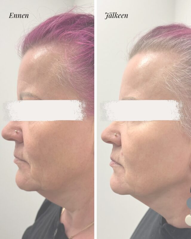 ✨ VEITSETÖN KASVOJENKOHOTUS – HARMONYCA ✨Kun kasvojen napakkuus, kiinteys ja selkeämpi profiili ovat tavoitteena – tämä hoito tekee eron.Kuvassa ennen & jälkeen HarmonyCA-hoidon tulokset 💫❓Miksi HarmonyCA?
• Hybriditeknologia, joka yhdistää hyaluronihapon (HA) ja kalsiumhydroksiapatiitin (CaHA)
• HA antaa välittömän kohottavan vaikutuksen
• CaHA aktivoi ihon oman kollageenin tuotannon, jolloin iho kiinteytyy asteittain viikkojen ja kuukausien aikana
• Vaikutus kestää 18–24 kuukautta
• Hoito sopii erityisesti:
– poskipäille
– leuan linjan parantamiseen
– hamsteripussien alueelle
– alakasvojen kiinteyttämiseen‼️ BLACK WEEK ETU: HarmonyCA –20 %Voimassa 24.–30.11 tai niin kauan kuin aikoja riittää – ja niitä on rajoitetusti 🖤Hoidon ja upean loputuloksen takana on  sairaanhoitaja @firm.riikka 🫰