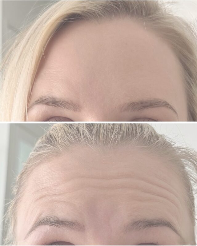 ✨ Nyt on täydellinen hetki tulla botuliinihoitoon ✨Botuliinihoidon tulokset kehittyvät asteittain – ja ovat parhaimmillaan noin 2–4 viikon kuluttua hoidosta.Eli jos varaat aikasi nyt, nautit raikkaasta ja levänneestä ilmeestä juuri juhlakauden tärkeimpinä hetkinä 🎄🥂Pikkujoulut, itsenäisyyspäivä, joulu ja uusivuosi – sädehdi itsevarmuutta jokaisessa juhlassa 💫💉 Hoidon on tehnyt sairaanhoitaja @firm.ninia
📍 Firm Medical Spa, Vantaa#botuliinihoito #firmmedicalspa #vantaa #kauneudenasiantuntija #esteettinenhoitolavantaa #pikkujoulukausi #juhlakausi #kauneushoidot #freshlook