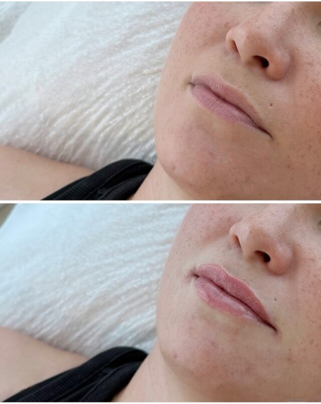 ✨ Vuoden 2025 viimeiset huulet ✨Pehmeät. Tasapainoiset. Ajattoman kauniit.Vuosi päättyy huoliteltuun lopputulokseen – joskus pieni viimeistely riittää tuomaan itsevarman fiiliksen uuteen vuoteen 💫Nämä huulet on tehnyt sairaanhoitaja @firm.ninia 🤍Firmissä huulet tehdään aina kasvojen mittasuhteita kunnioittaen, rauhallisesti ja ammattitaidolla.
Ei liioittelua – vain luonnollinen, huoliteltu lopputulos.Kiitos kaikille asiakkaille tästä vuodesta 🤍
Kohti vuotta 2026, kauniisti.#firmmedicalspa #huultenmuotoilu #täyteainehoidot  #luonnollinenkauneus #esteettinensairaanhoitaja #uusivuosi2026